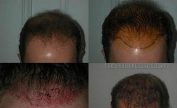 Before and after pictures from 2115 grafts hair transplant