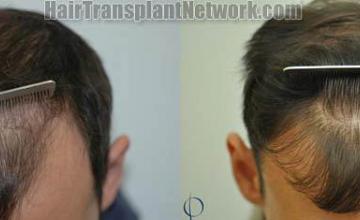 Hair transplantation surgery before and after photos