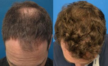 Top view before and after hair restoration results