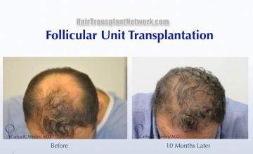 Hair transplantation surgery before and after pictures