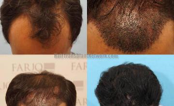 Hair transplantation surgery before and after photos