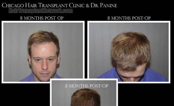 Hair restoration procedure before and after pictures