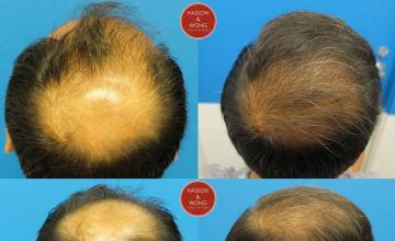 Hair restoration procedure before and after pictures