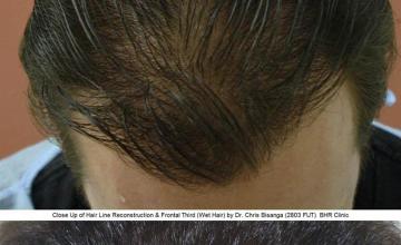 Hair transplantation surgery before and after images