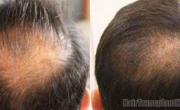 Hair transplantation surgery before and after pictures