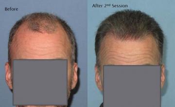 Hair restoration procedure before and after results