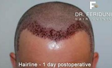 Hair restoration procedure before and after results