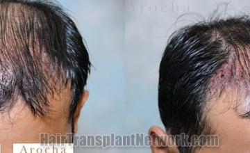 Hair restoration procedure before and after pictures