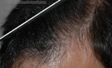 Hair restoration procedure results