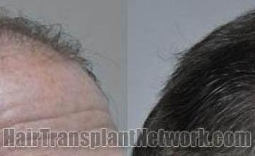 Hair transplantation surgery before and after images