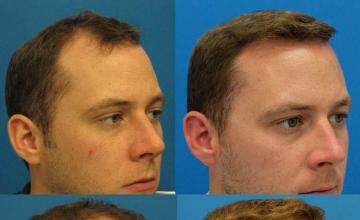 Hair transplantation surgery before and after photos