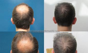 Hair restoration procedure before and after pictures