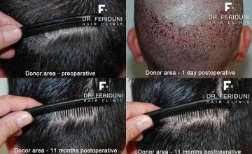 Hair transplantation surgery before and after pictures