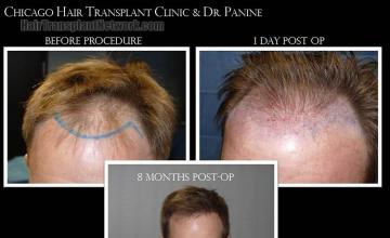 Hair transplantation surgery before and after photos