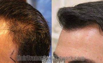 Hair transplantation surgery before and after images