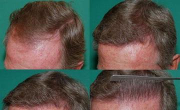 Left side showing before and after hair restoration 