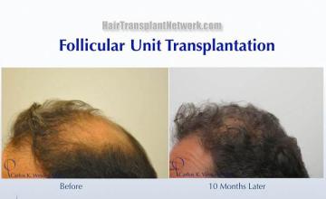 Hair transplantation surgery before and after photos