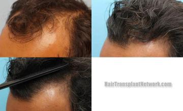 Hair transplantation surgery before and after pictures