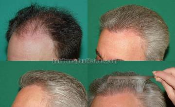 Hair transplantation surgery before and after pictures