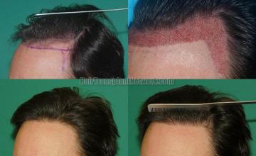 Hair transplantation surgery before and after pictures