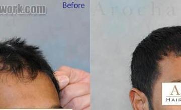 Hair transplantation surgery before and after images