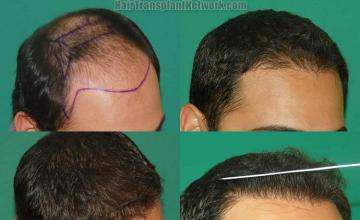 Hair transplantation surgery before and after images