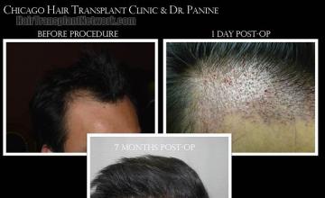 Hair transplantation surgery before and after photos