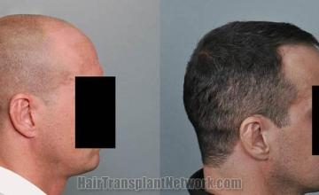 Hair transplantation surgery before and after images