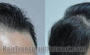 Hair transplantation surgery before and after images