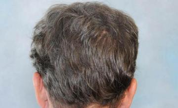 Hair restoration procedure before and after pictures