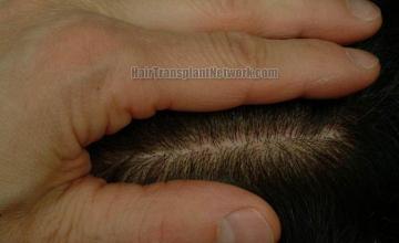 Hair transplantation surgery before and after pictures