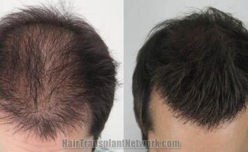 Hair transplantation surgery before and after pictures