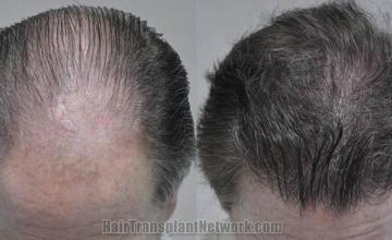 Hair transplantation surgery before and after photos