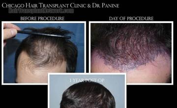 Hair transplantation surgery before and after images