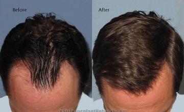 Hair transplantation surgery before and after photos