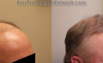 Hair transplantation surgery before and after photos