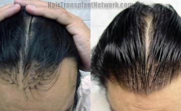 Hair restoration before and after repair pictures