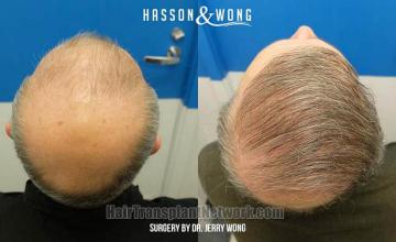 Hair restoration procedure before and after pictures