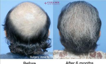 Surgical hair transplantation result photographs