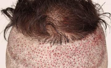 Surgical hair transplantation result photographs