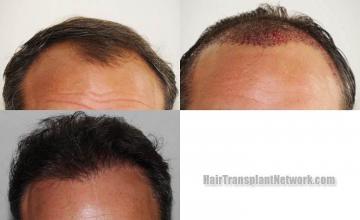 Before and after hair restoration repair surgery
