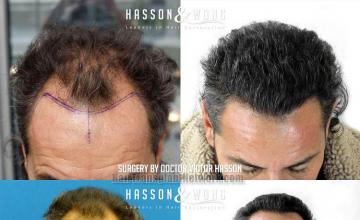 Front view - Before and after hair restoration procedure