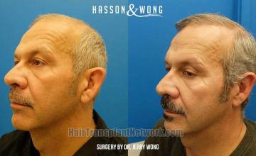 Hair transplantation surgery before and after pictures