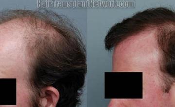 Left view before and after hair transplant