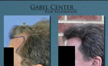 Left view images before and after hair transplantation