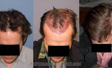 Tilt down view before and after hair transplant photos