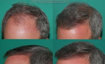 Photos showing before and after hair transplant results