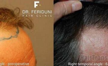 Hair restoration photos viewing right oblique angle results