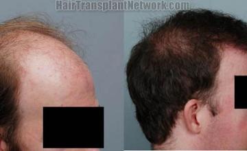 Hair transplant before and after pictures