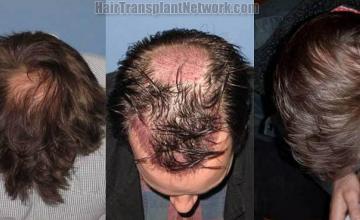 Top view before and after hair restoration procedure images